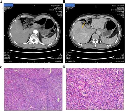 Case Report: Solitary metastasis to the appendix after curative treatment of HCC